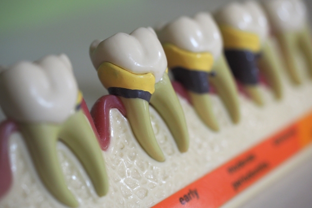 三鷹（三鷹市下連雀）の歯医者、川島歯科医院の歯ぎしり対策