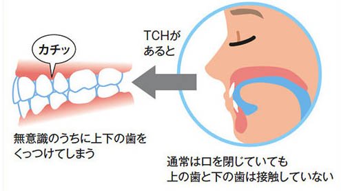 三鷹（三鷹市下連雀）の歯医者、川島歯科医院の歯列接触癖対策