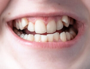 三鷹の歯医者、川島歯科医院で、ガチャ歯（叢生）とは？原因やリスク、治療法を解説