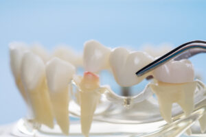 三鷹の歯医者、川島歯科医院で、ブリッジ治療後の支台歯の寿命を延ばすメンテナンス方法を解説