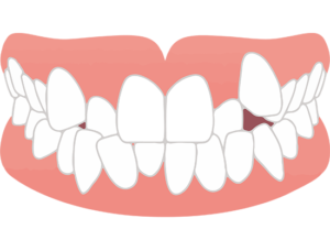 三鷹の歯医者、川島歯科医院で、ガチャ歯（叢生）とは？原因やリスク、治療法を解説